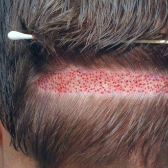 Best Hair  Transplant In Lahore