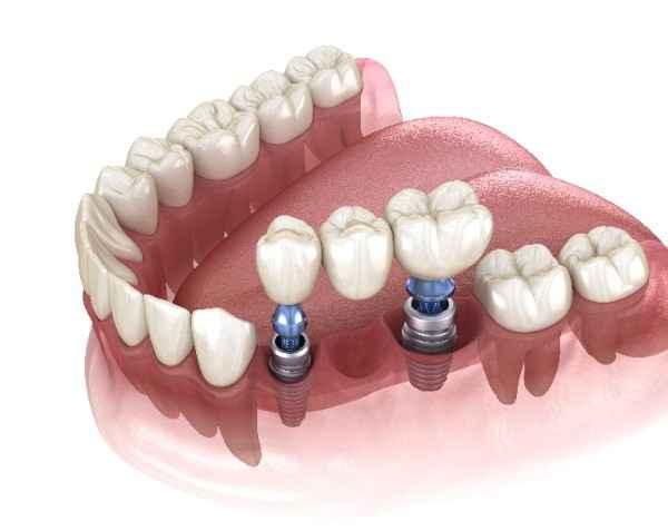 dental implants Wolverhampton