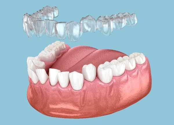 dental implants Wolverhampton