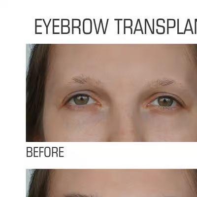Eyebrow  Transplant Dubai